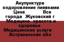 Акупунктура, оздоровление пиявками › Цена ­ 3 000 - Все города, Жуковский г. Медицина, красота и здоровье » Медицинские услуги   . Астраханская обл.